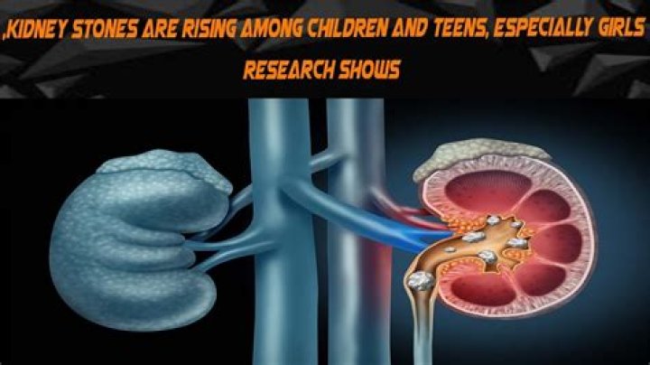 Kidney stones are rising among kids and teens, especially girls