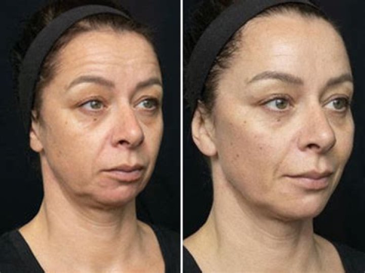 The New 'Revolutionary' Rejuvenation Procedure That Can Transform Your Face