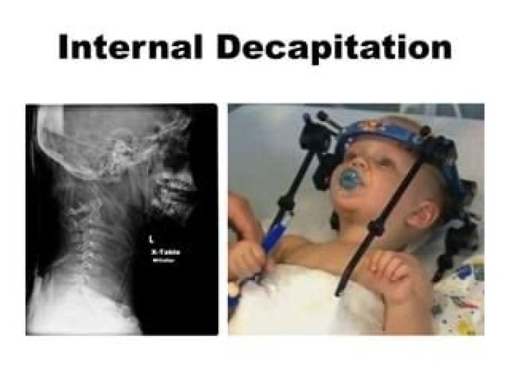 Toddler's Head Reattached After Internal Decapitation