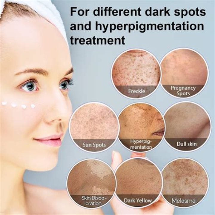 Treatment For Pigmentation: How To Beat Age Spots